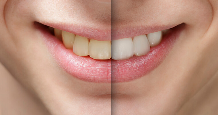Before and after a teeth whitening treatment